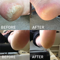 Hard skin clearance on heel treatment